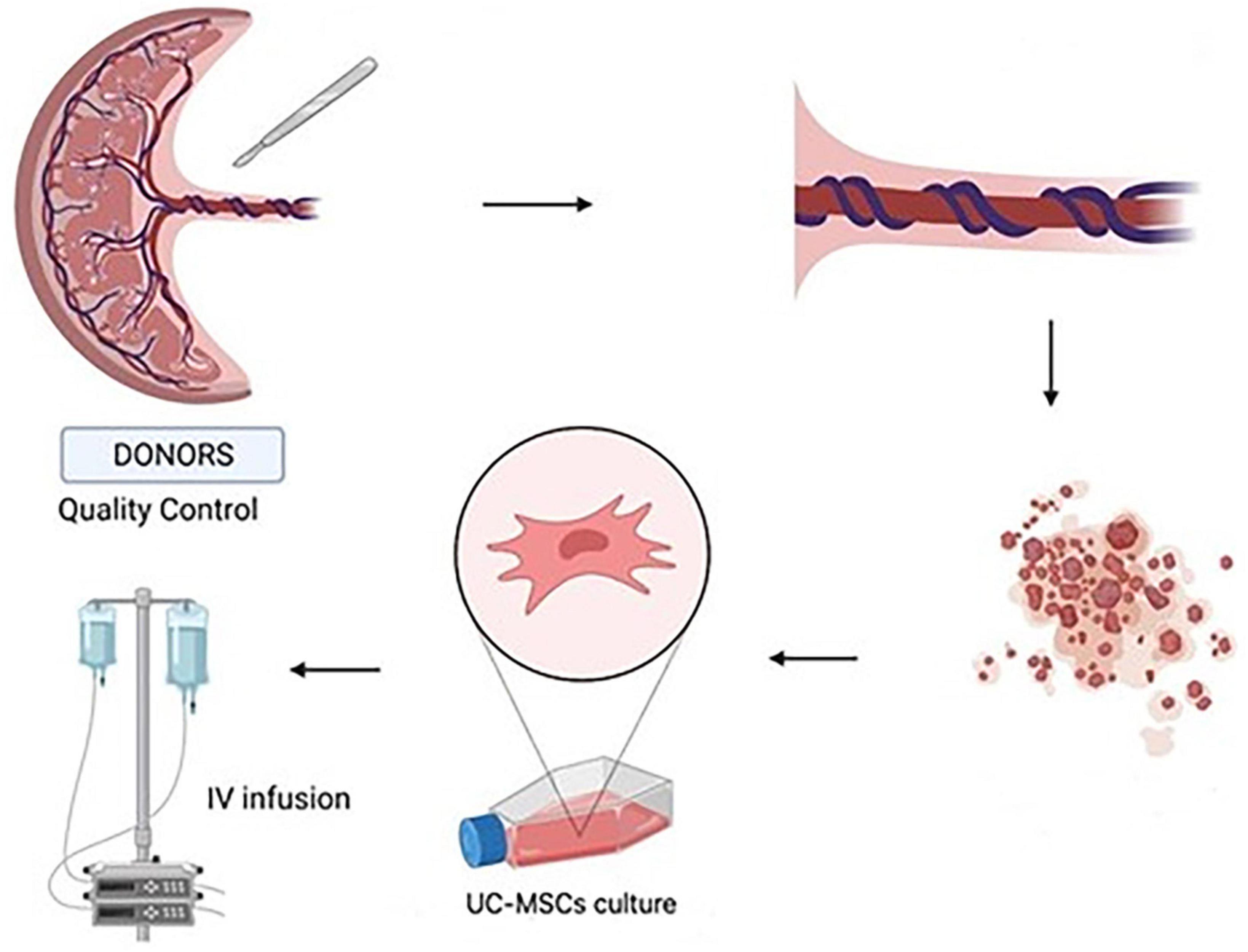 Clinical experience: Outcomes of mesenchymal stem cell transplantation in five stroke patients